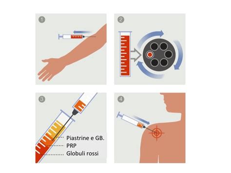 Infografica che mostra il processo di preparazione del PRP (prelievo, centrifugazione, iniezione)