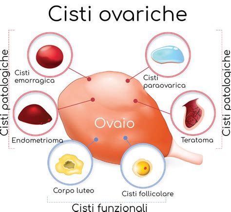 Illustrazione anatomica delle ovaie e dell'utero con una cisti ovarica
